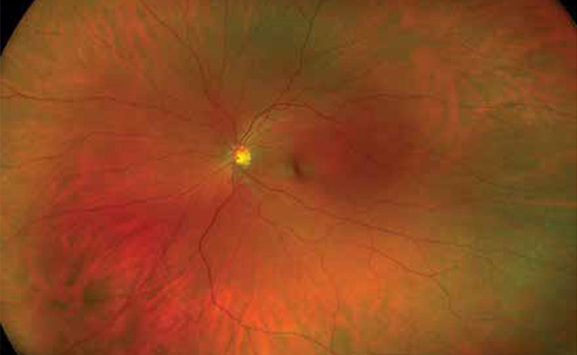 Drs. Shannon Chandler and Lesa Davis | Optos Retinal Exam, Comprehensive Eye Exams and Treatment of Ocular Allergies